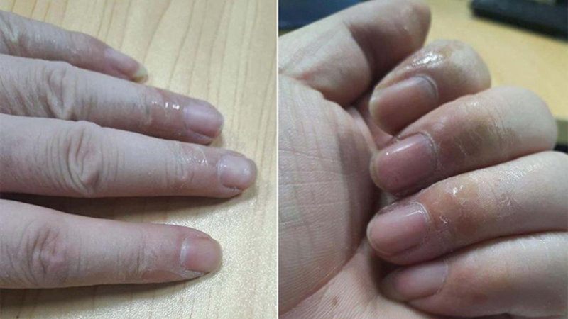 Cách gỡ khi Keo 502 rơi vào da an toàn tránh tổn thương da hiệu quả nhất